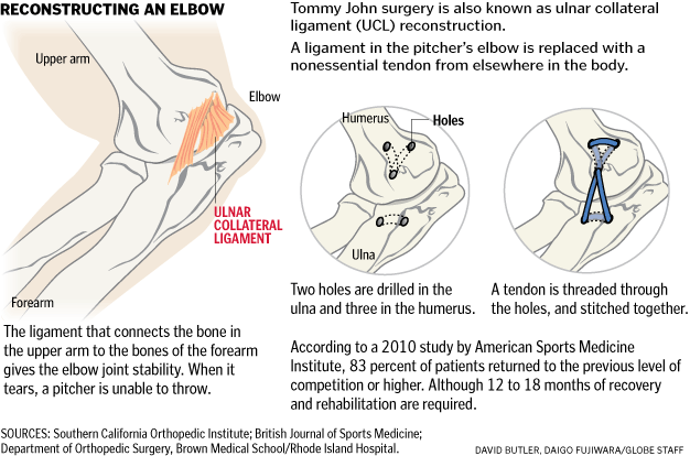 Tommy John