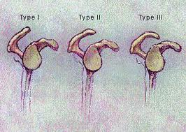 Acromion Types