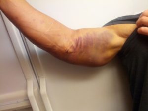 Injured Elbow