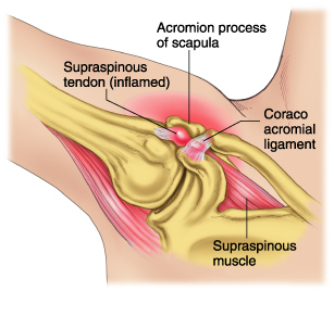 shoulder-impingement